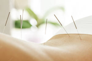 Caption: Experienced Acupuncturist Performing Back Needle Therapy Wallpaper